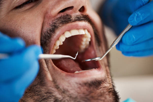 Best Emergency Wisdom Teeth Removal in Bloomingdale, FL